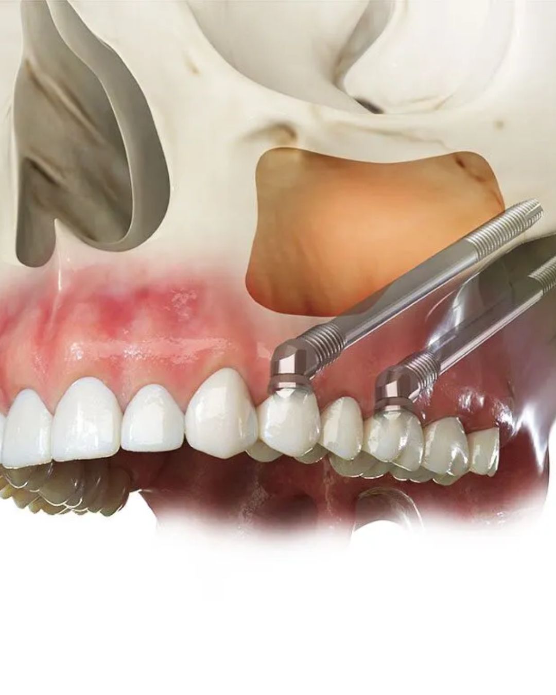 Implantes cigomáticos