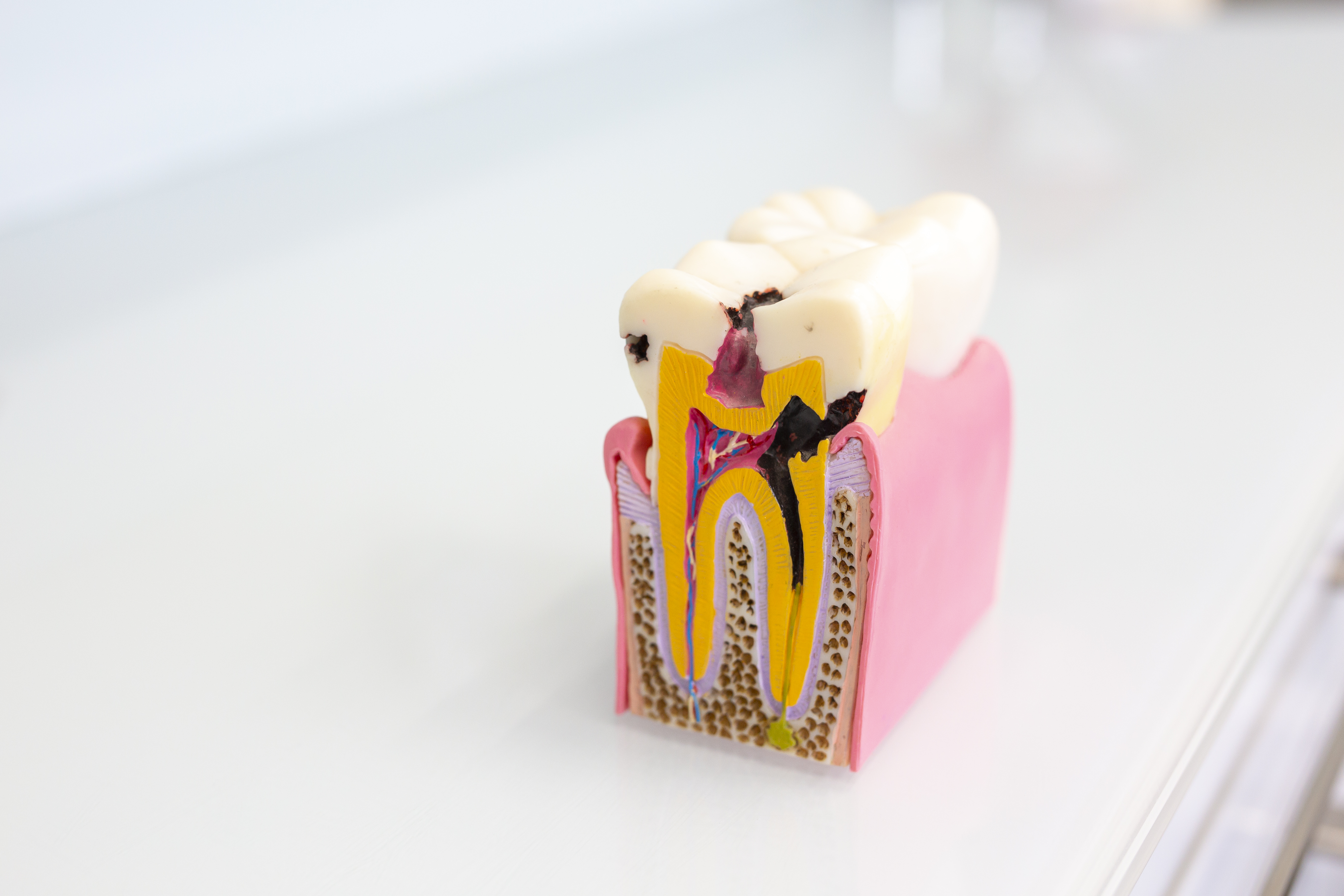 tipos de caries
