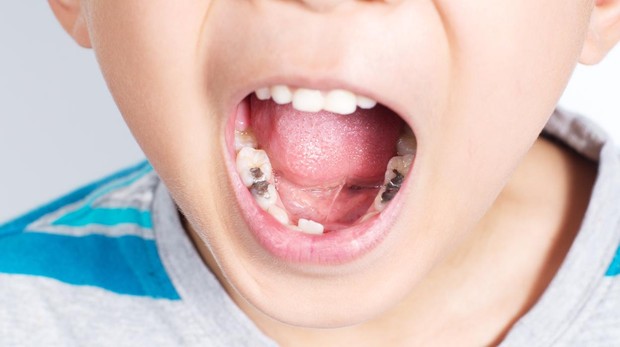 Cepillado Menores