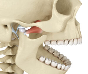 Bloqueo Mandibular