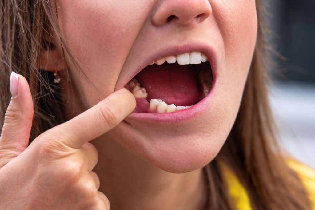 consecuencias de no reemplazar los dientes perdidos
