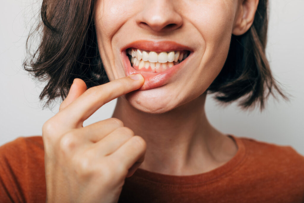 cómo prevenir la gingivitis