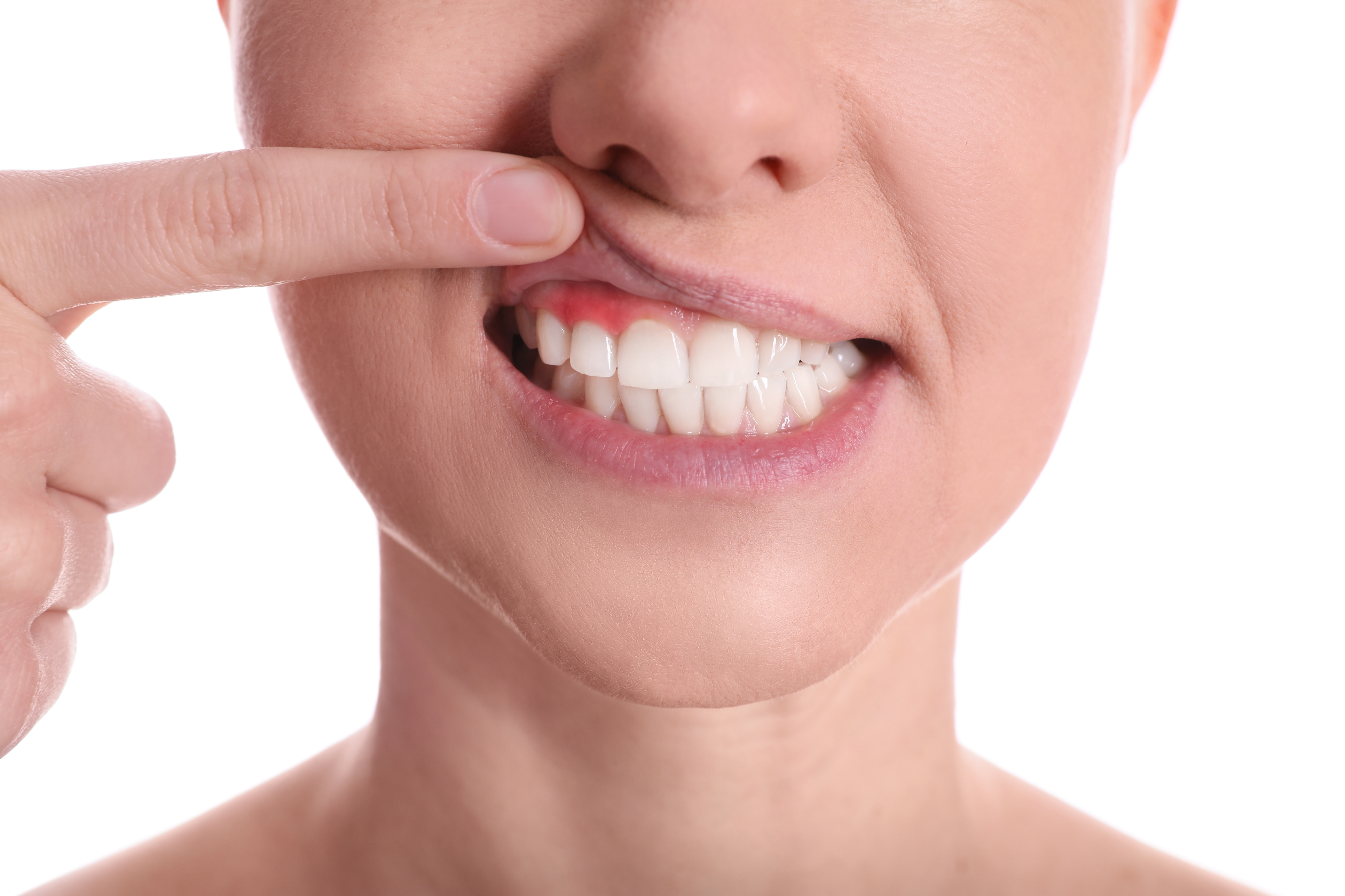 gingivitis o periodontitis