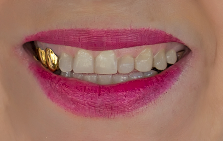 riesgos de los grillz dentales