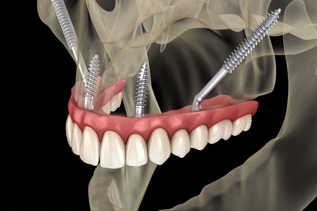 Implantes Cigomaticos